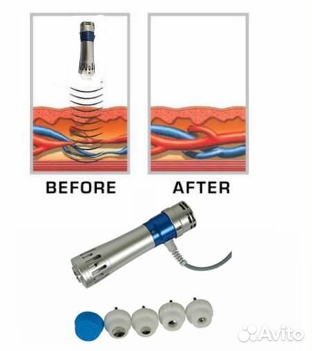 Аппарат Ударно-Волновой Терапии