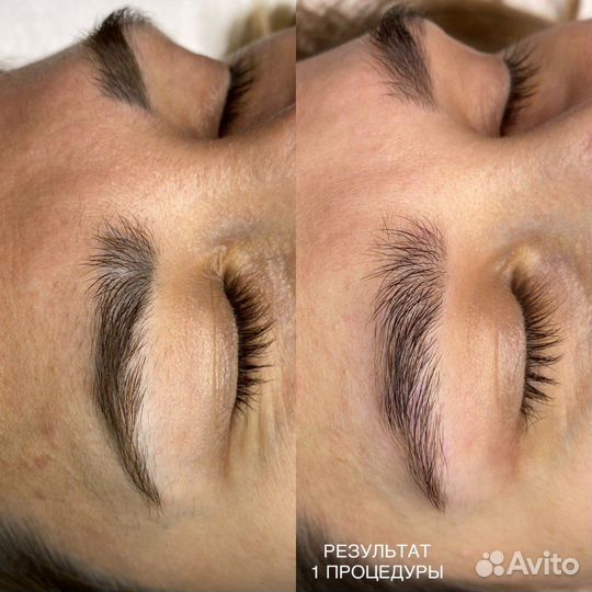 Удаление тату татуировок татужа, модель