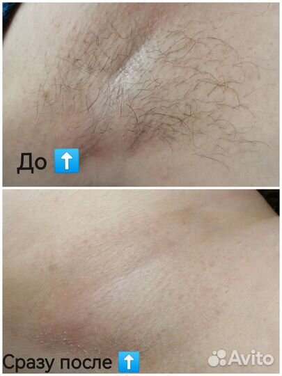 Электроэпиляция