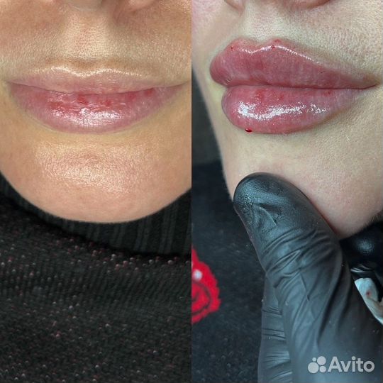 Модель на увеличение губ