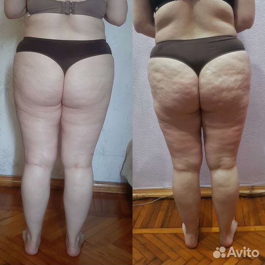 Антицеллюлитный массаж