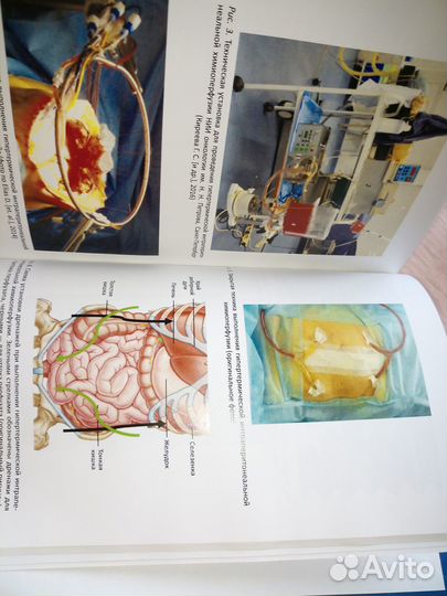 Химиоперфузионное лечение злокачественных опухолей