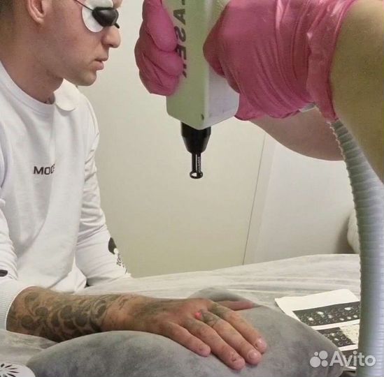 Удаление тату, удаление татуажа