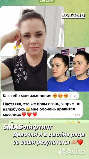 Модели SMAS лифтинг