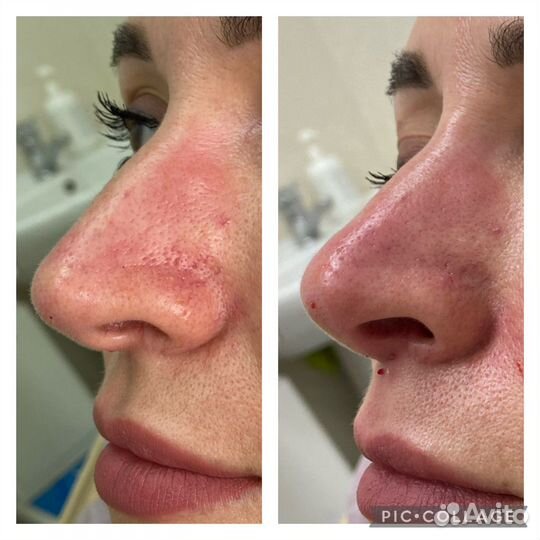 Биоревитализация