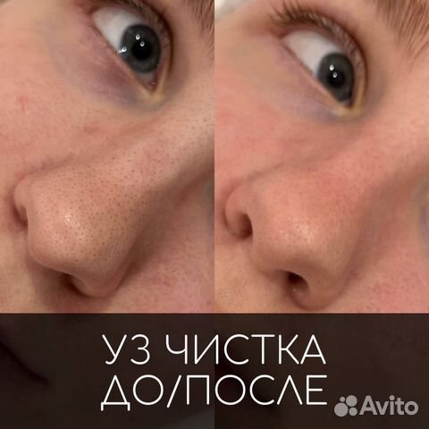 Ультразвуковая чистка лица