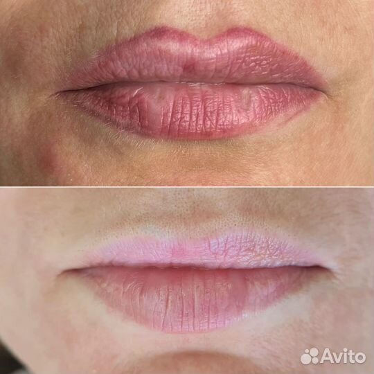 Удаление тату и татуажа