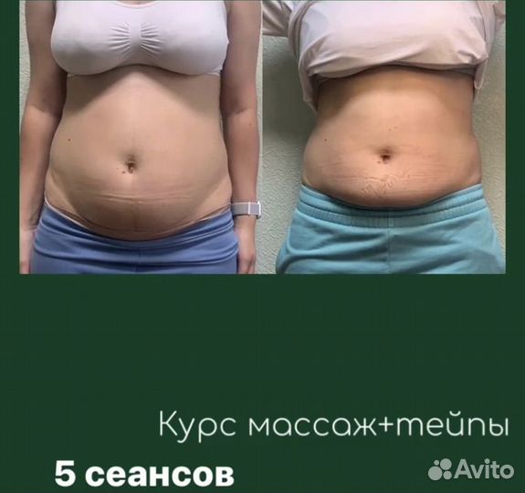 Тейпирование