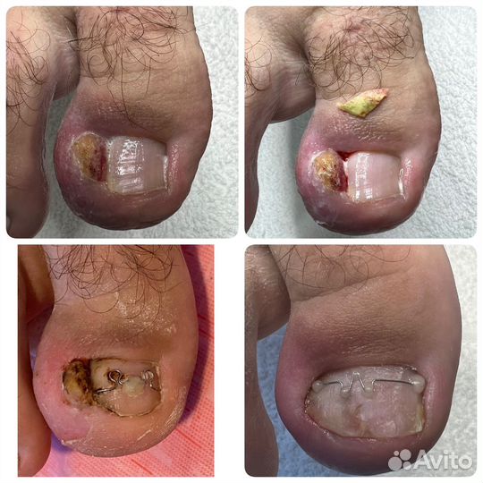 Подология лечение ногтей