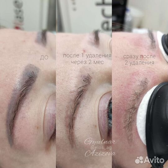 Удаление тату/татуажа (перманента)