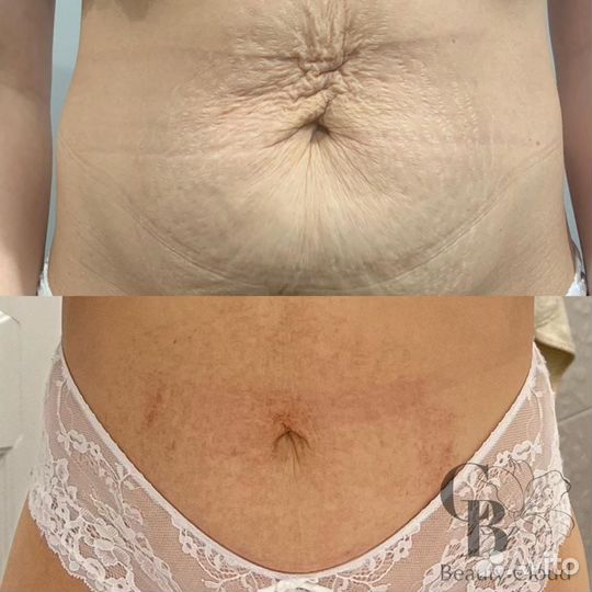 Холодная плазма. Обучение