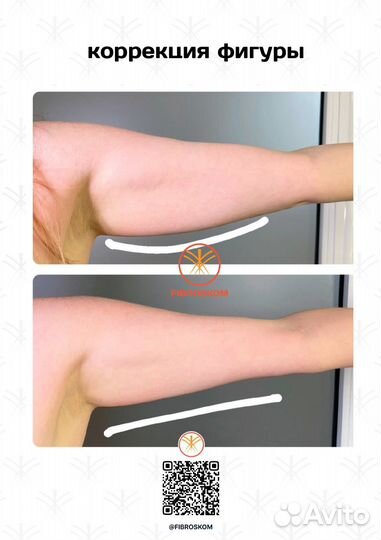 Подтяжка кожи на теле и руках