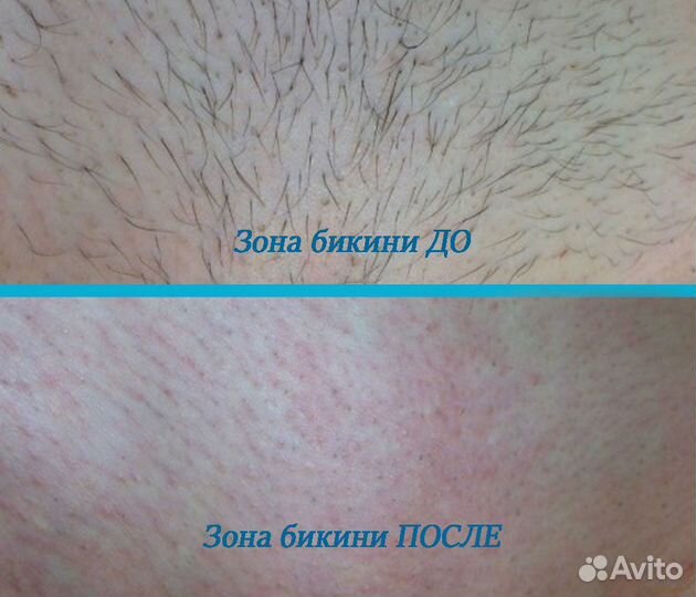Электроэпиляция