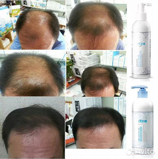 Спрей от выпадения волос Атоми Корея