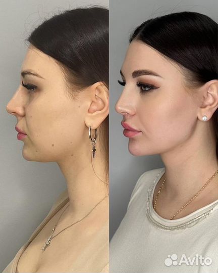 «Wow» Лифтинг - Коррекция овала лица