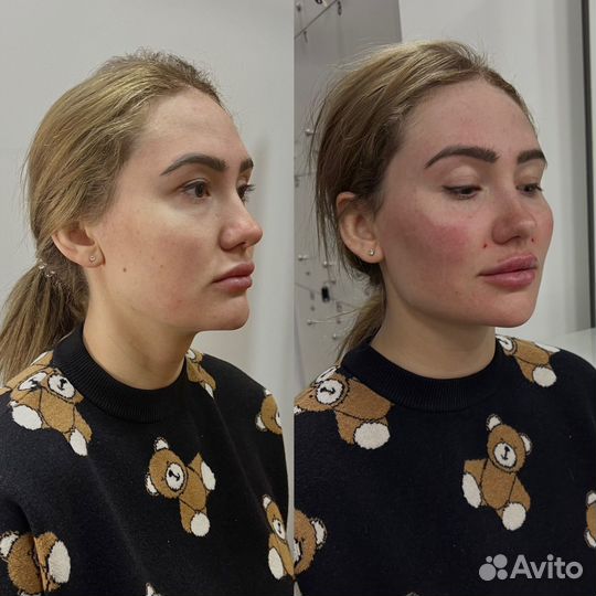 Требуются модели на нити. Косметолог