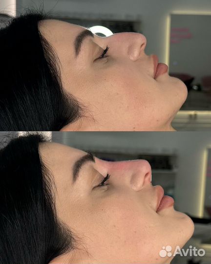 Косметолог. Уменьшение носа навсегда