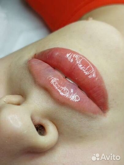 Увеличение губ косметология ботокс