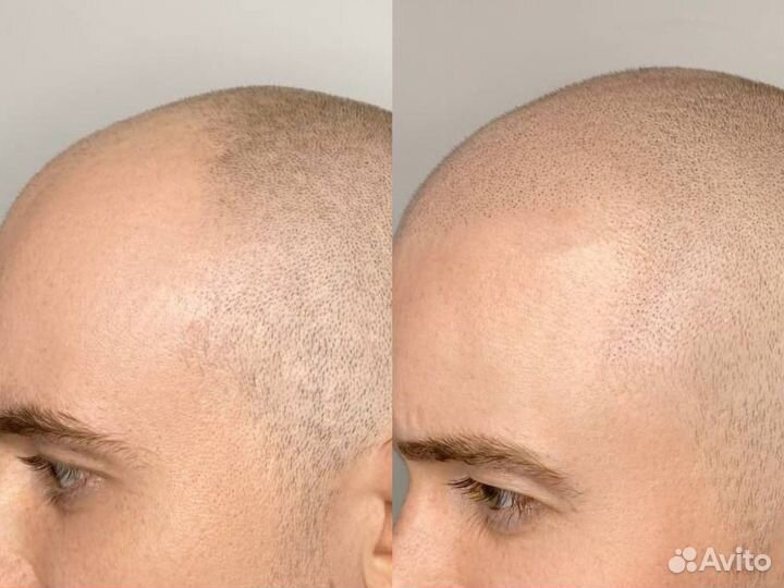 Ищу модель на трихопигментацию SMP