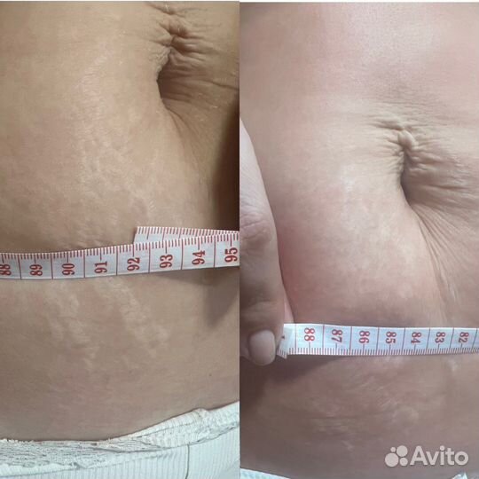 Антицеллюлитный массаж