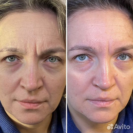 Массаж лица лифтинг и лимфодренаж