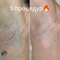 Лазерная эпиляция, Санкт-Петербург