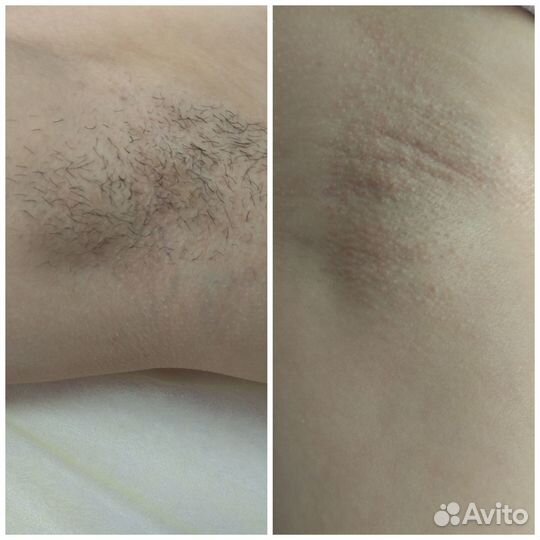 Депиляция воском