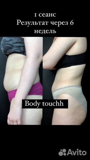 Антицеллюлитный массаж, Липопластика