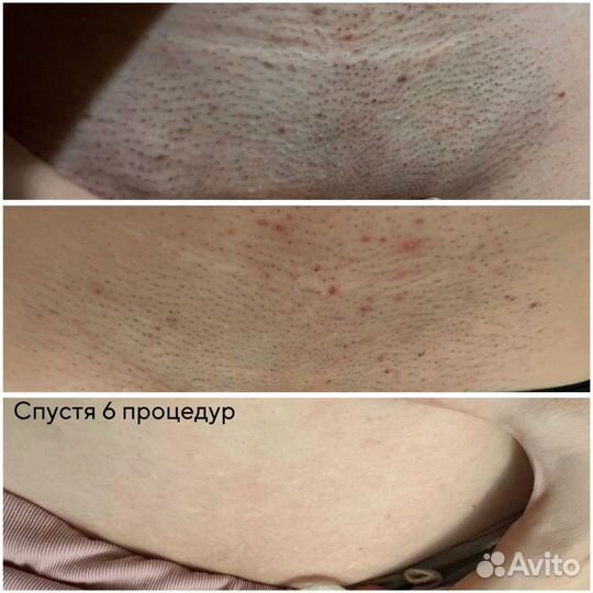 Elos эпиляция