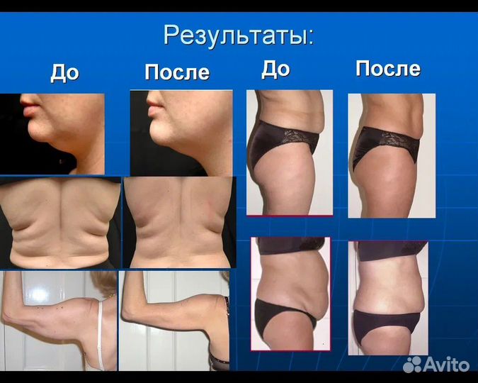 Лазерный липолиз (похудение)