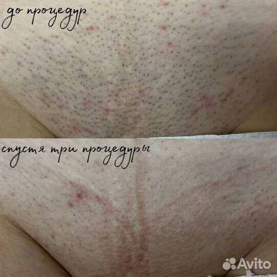 Лазерная эпиляция в студии Velvet