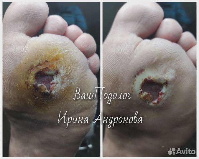 Подолог.Педикюр,вросший ноготь,трещины,мозоли