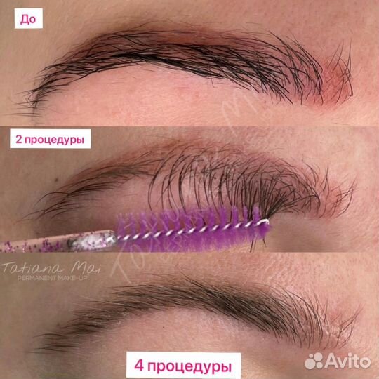 Удаление ремувером татуажа