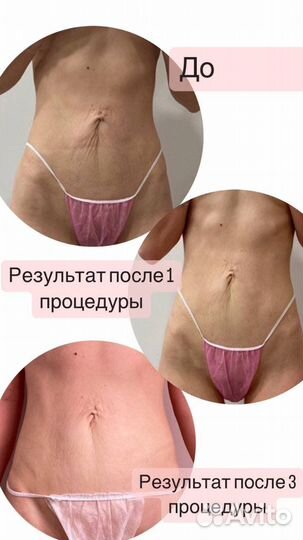 Похудение без диет и тренировок. Омоложение. Смас