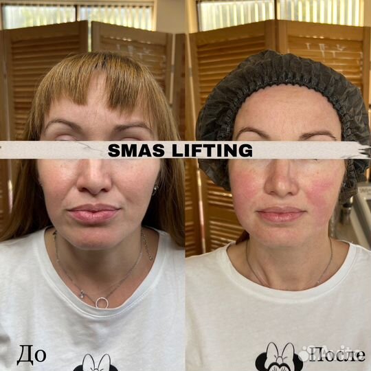 Smas lifting Омоложение кожи