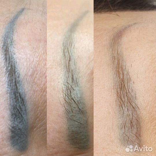 Лазерное удаление татуажа и татуировок