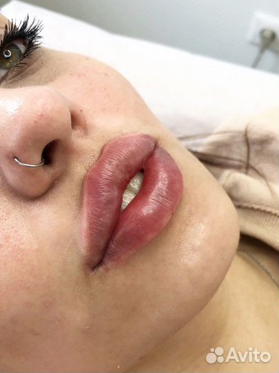 Увеличение губ, скулы, ботокс, плазмолифтинг