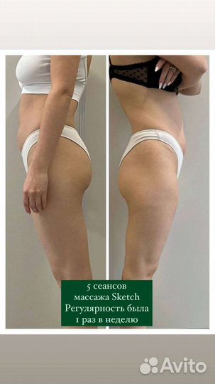 Антицеллюлитный аппаратный массаж