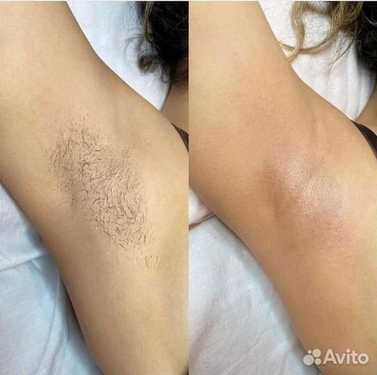 Лазерная эпиляция