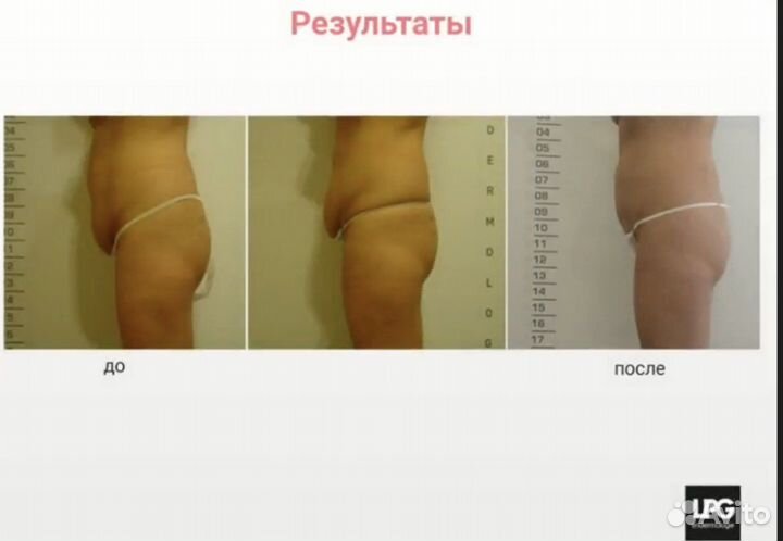 Lpg массаж лица и тела