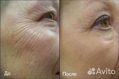 Мезороллер для лица и тела. Дермороллер