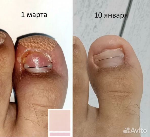 Подолог, титановая нить, вросший ноготь. Азино