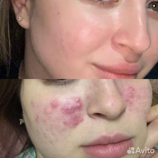 Фотоомоложение лечение постакне сосудов lumecca