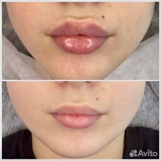 Коррекция губ, увеличение губ