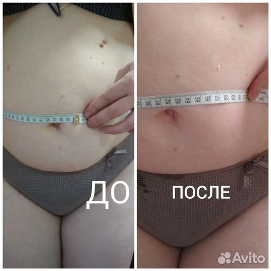 RF-лифтинг. Аппаратная косметология