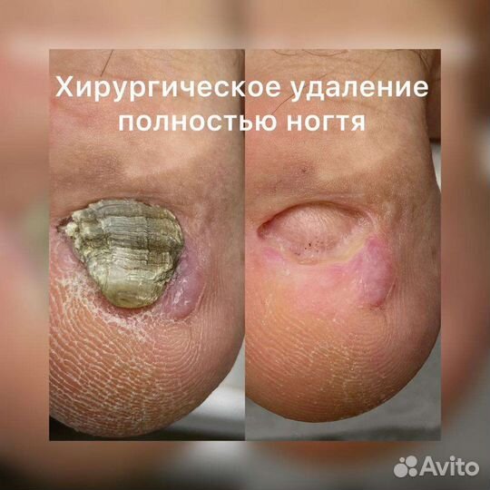 Медицинский педикюр. Подолог