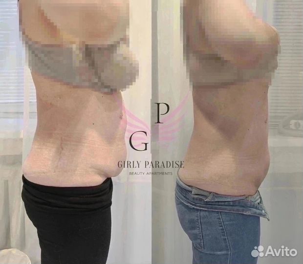 Криолиполиз