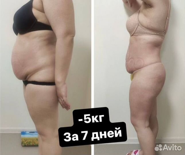 LPG массаж. Коррекция фигуры. Похудение