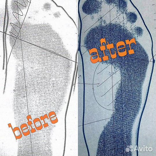 Изготовление индивидуальных стелек