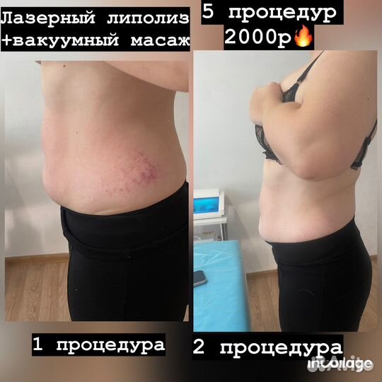 Аппаратная коррекция фигуры